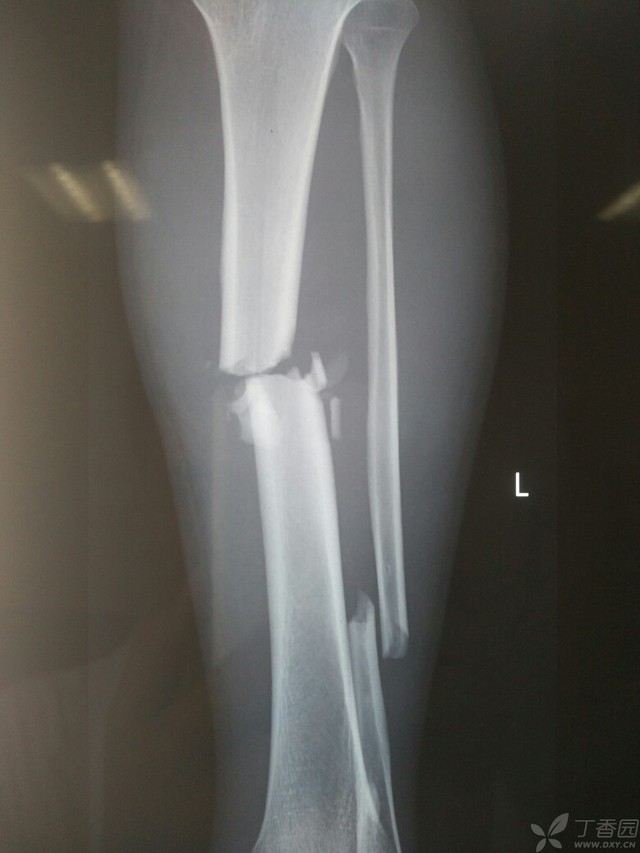 科技重塑脛腓骨骨折康復(fù)之旅，引領(lǐng)未來體驗新篇章