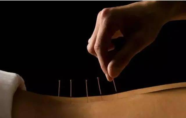 平衡針灸最新視頻，現(xiàn)代應(yīng)用探索針灸藝術(shù)的新境界