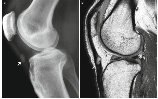 髕腱炎成為醫(yī)學(xué)焦點(diǎn)，從幕后走向舞臺(tái)中央的最新進(jìn)展