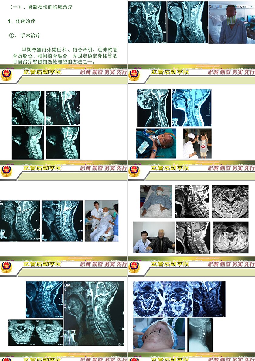 2023年脊髓損傷研究新進展，里程碑式的突破與日常奇妙變化