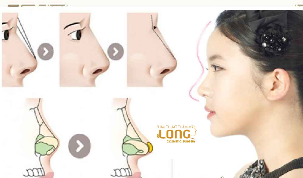 最新鼻整形技術(shù)重塑自信，煥發(fā)新生之美