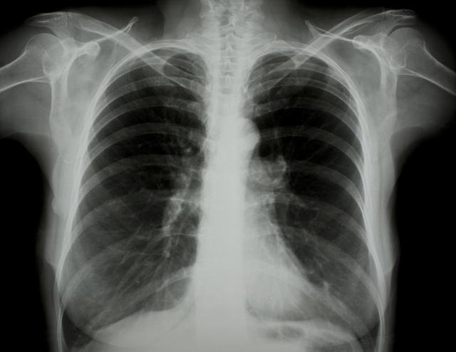撫順肺炎最新動態(tài)與全面步驟指南