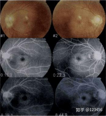 最新藥肺炎詳解，你需要知道的一切——健康小紅書